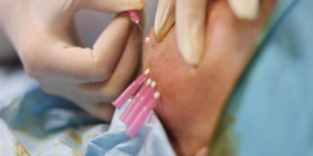 Jak probíhá prime lifting mezonitěmi?