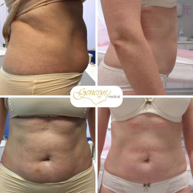 Rychlá a efektivní redukce podkožního tuku bez operace